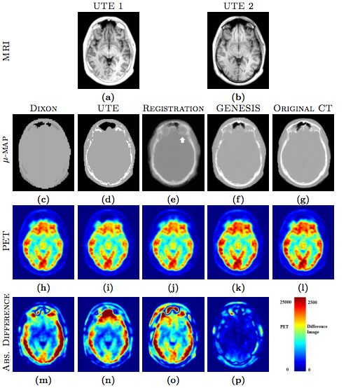 Pet Attenuation Correction Using Synthetic Ct From Ultrashort Echo Time Mri Iacl